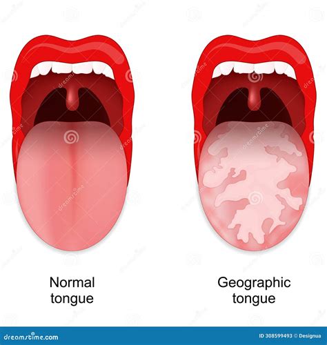 Geographic Tongue Migratory Glossitis Glossal Lesions In A Patient