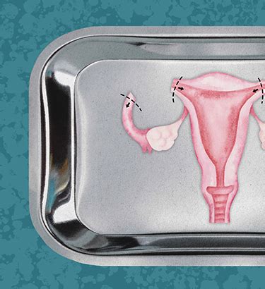 Image result for Removing Fallopian Tubes