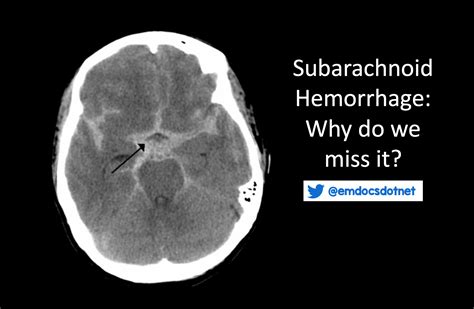 Intracerebral Hemorrhage Vs Subarachnoid Hemorrhage