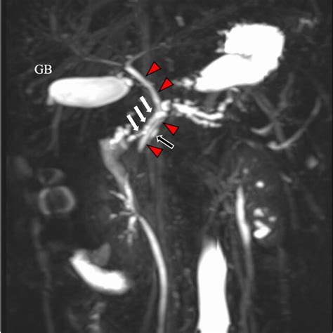Image result for Abnormal MRCP
