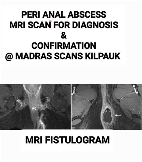 Ischiorectal Abscess Mri