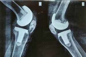 Loose infected right Knee Replacement Implant | Dr. Kiran Kharat | Dr ...