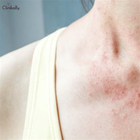 Managing Urticaria (Hives): Causes & Treatment Plans | Clinikally
