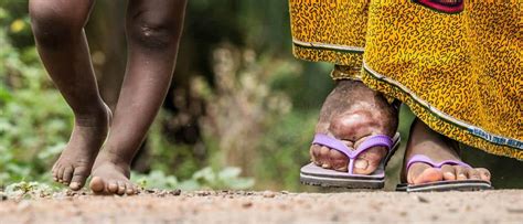 What is Lymphatic Filariasis?