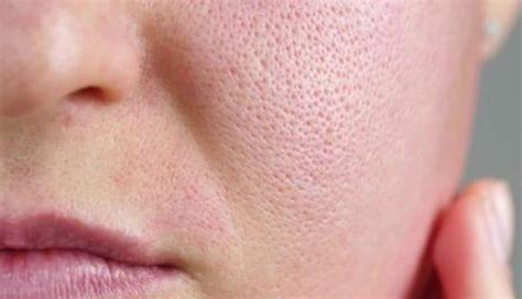 Comedonal Acne: Causes, How To Treat It, & Ways To Prevent It ...