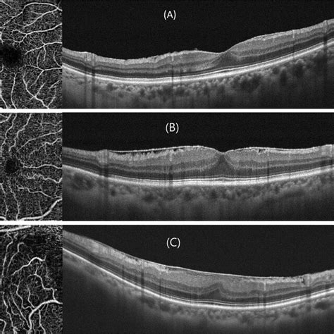 Image result for Optical Coherence Tomography Tutorial