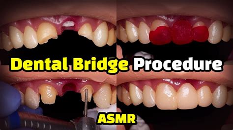 Homemade Dental Bridge 的图像结果