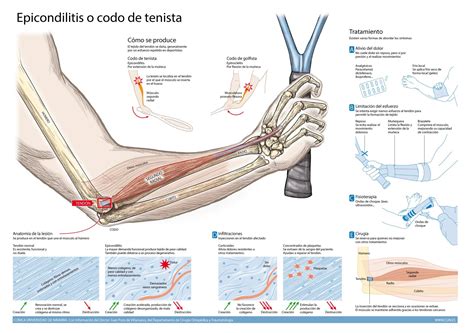 Dolor en codo. Epicondilitis. Codo del tenista. Síntomas y tratamiento. CUN