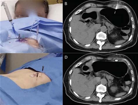 Endoscopic Guided Percutaneous Gastrostomy at Marion Rosenthal blog