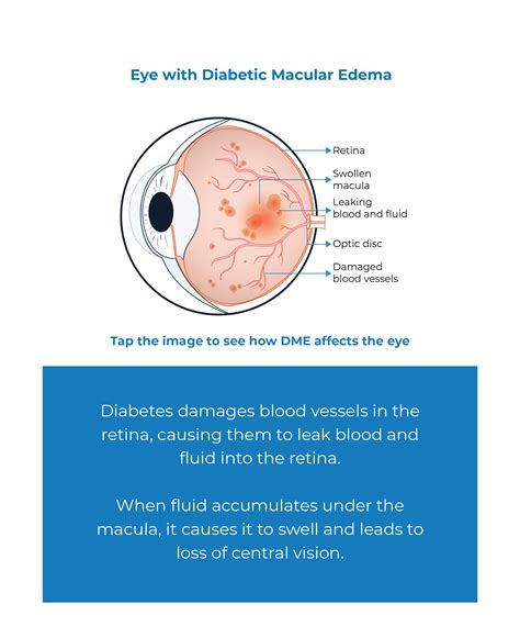 DME - Diabetic Macular Edema - Kodiak Sciences