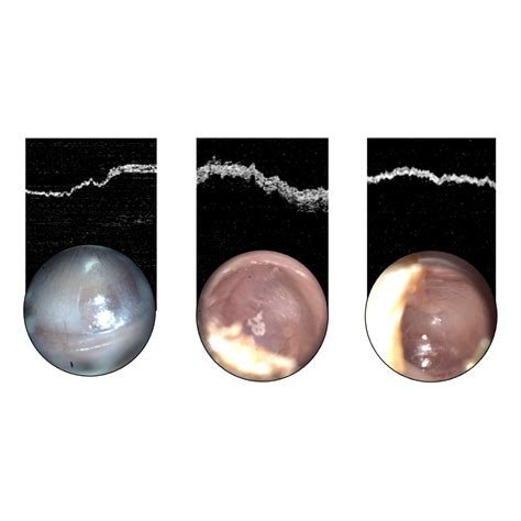 Inner Ear Infection Otoscope
