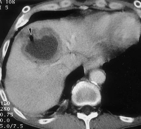 Liver cyst causes, symptoms, diagnosis & treatment