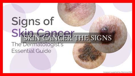 Types Skin Cancer Signs 的图像结果