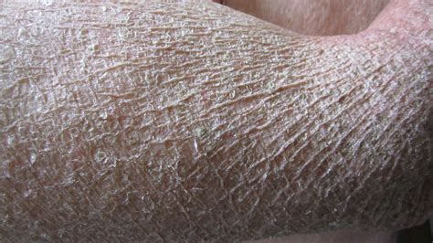 Fish Scale Disease In Dogs at Heather Morgan blog