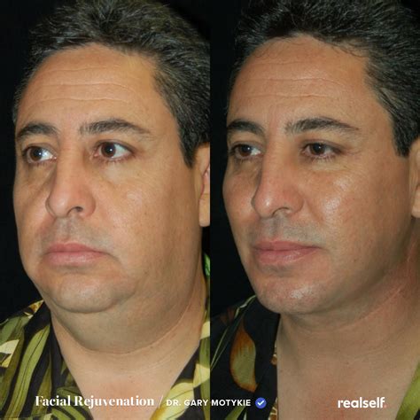 Lower Facelift vs. Neck Lift: What’s the Difference? | Neck lift, Face lift surgery, Fat grafting
