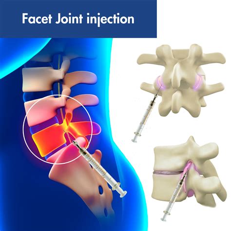 Facet Joint Injection Madison, WI | Pro Spine & Pain