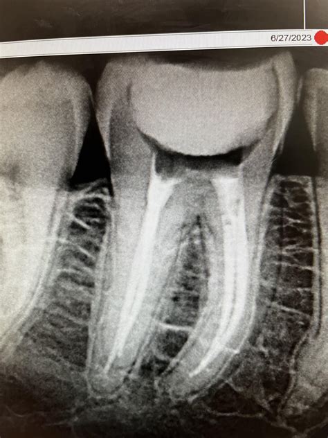 RCT tooth #30. : r/askdentists