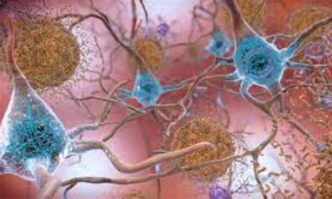 Complete amyloid plaque clearance with donanemab slows progression of ...