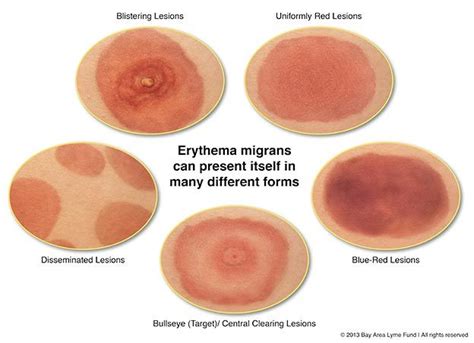 lyme disease endemic areas