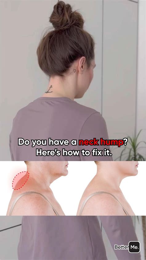 How to fix your neck hump fast home exercises dr mandell – Artofit