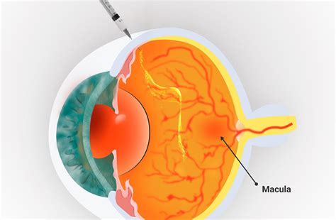 Image result for IVT Injection