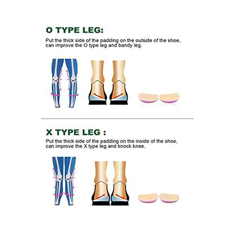 Flat Foot Treatment: India's Podiatry Clinic – Curafoot