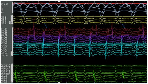 Electrophysiologic Considerations in Adult Patients with Ebstein’s Anomaly
