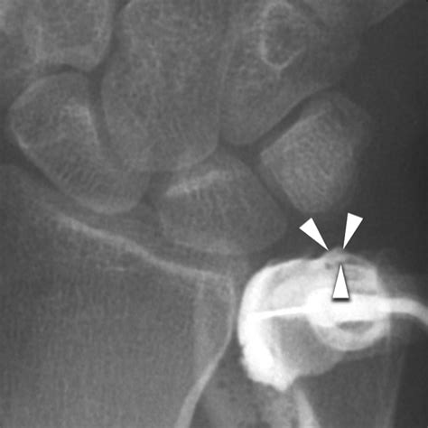 Peripheral Tear of the Triangular Fibrocartilage: Depiction with MR ...