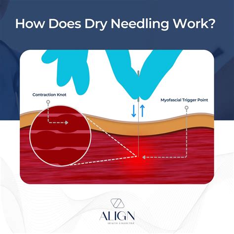 Dry Needling in Brisbane | Pain Relief & Recovery | AlignHC