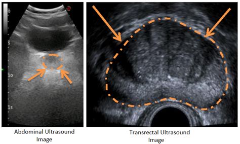 Benign Prostatic Hypertrophy Ultrasound