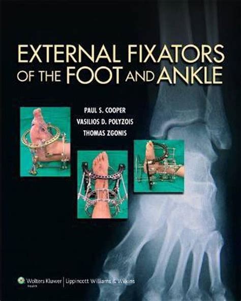 External Fixators of the Foot and Ankle: Buy External Fixators of the ...