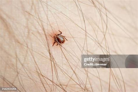 Image result for Embedded Deer Tick