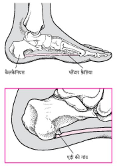 Image:एड़ी की कील क्या होती है?-MSD Manual Consumer Version