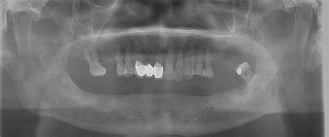 Dental CT scan vs. Cone Beam CT: an overview - ITI Blog