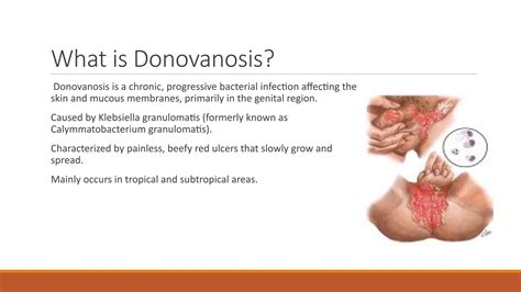 Donovanosis - Understanding Granuloma Inguinale (Dermatology ...