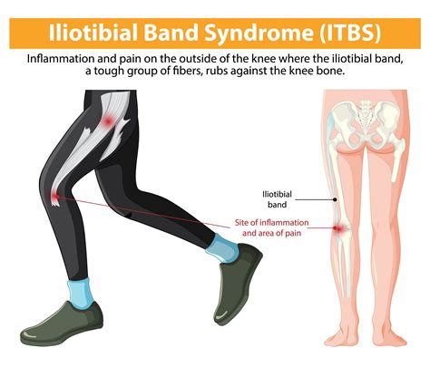 Osteopathy For Iliotibial Band Syndrome ITBS Pain