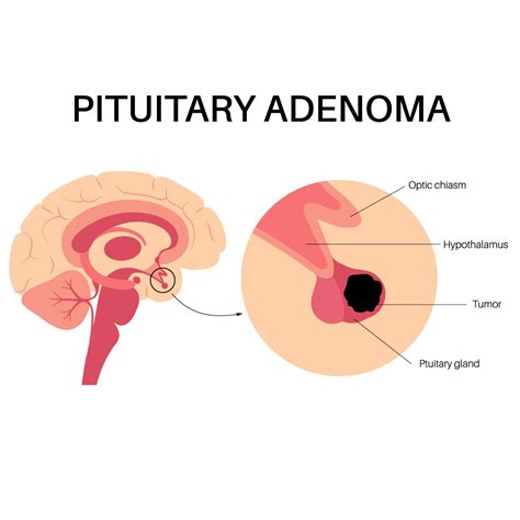 Pituitary Gland Tumor Symptoms In Women Pituitary Tumor | North
