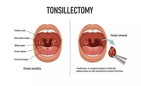 Uvula Swollen After Tonsillectomy Tonsil Hypertrophy Dr. Jonathan