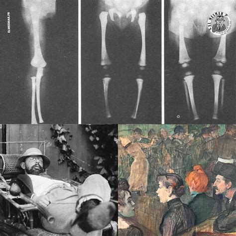 La pycnodysostose, ou syndrome de Toulouse-Lautrec - MESMAR