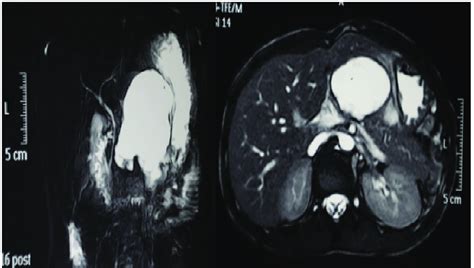Image result for Abnormal MRCP