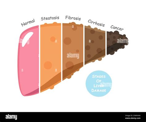 Stages of liver damage include steatosis or fatty liver, fibrosis, cirrhosis and cancer or ...
