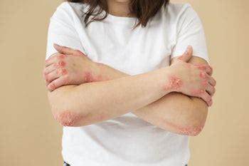 Differentiating Hives and Rashes: Identifying Key Distinctions ...