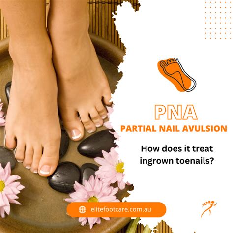 Understanding Ingrown Toenails and the Partial Nail Avulsion (PNA) Procedure - Elite Foot Care ...