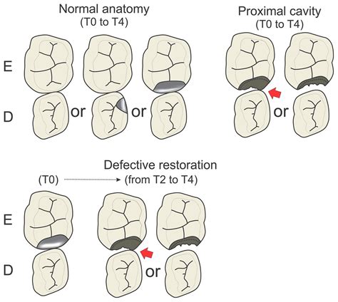 Does treating proximal cavities in primary molars non-restoratively ...