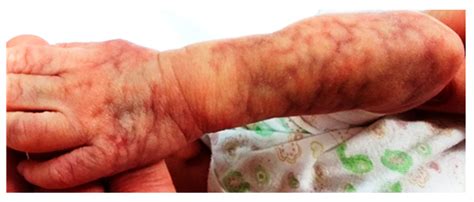 Mottled Skin Infant