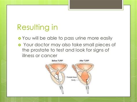 Image result for Turp Procedure Explained