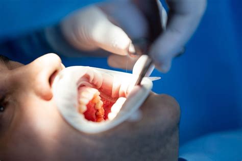 Tooth Extraction Healing Stages: Day-by-Day Recovery Guide