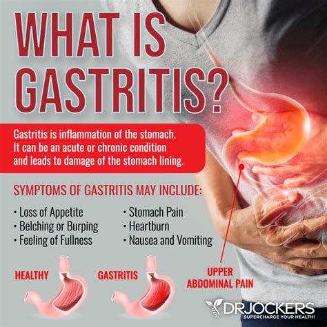 Acute Gastritis Gastritis】Distinguishing Acute Gastritis From