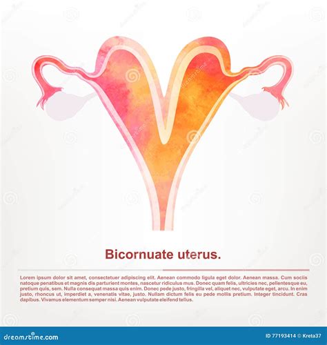 Bicornuate Uterus And Pregnancy. One Uterine With Fetus, Child. Second ...