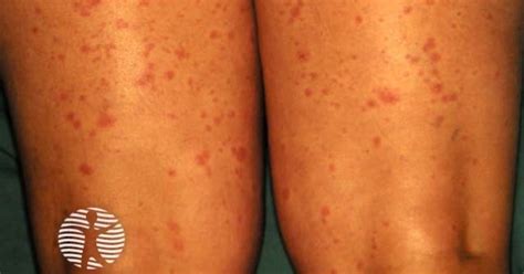 Rash Pictures SJS 的图像结果